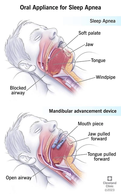 Airway graphic