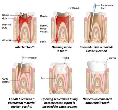 A graph of root canal treatment